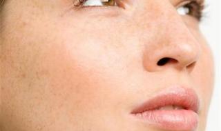 人脸上的斑点如何去掉 人脸上的斑点如何去掉